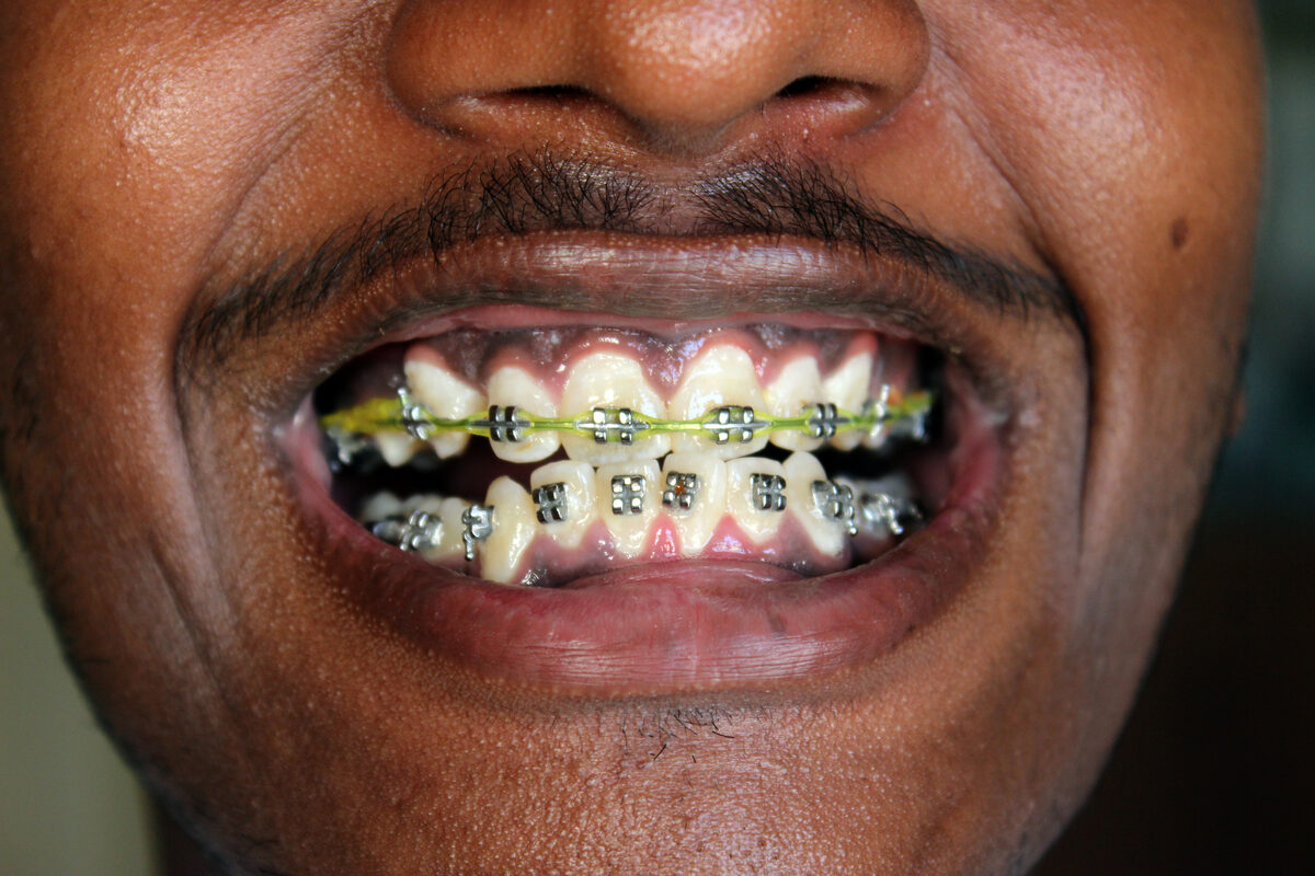 LightForce Hands the CEO Job to a Medtech Closer as 3D-Printed Braces Scale Up